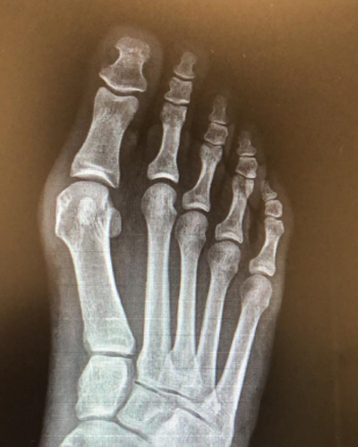 Deformitat d’Hallux Valgus