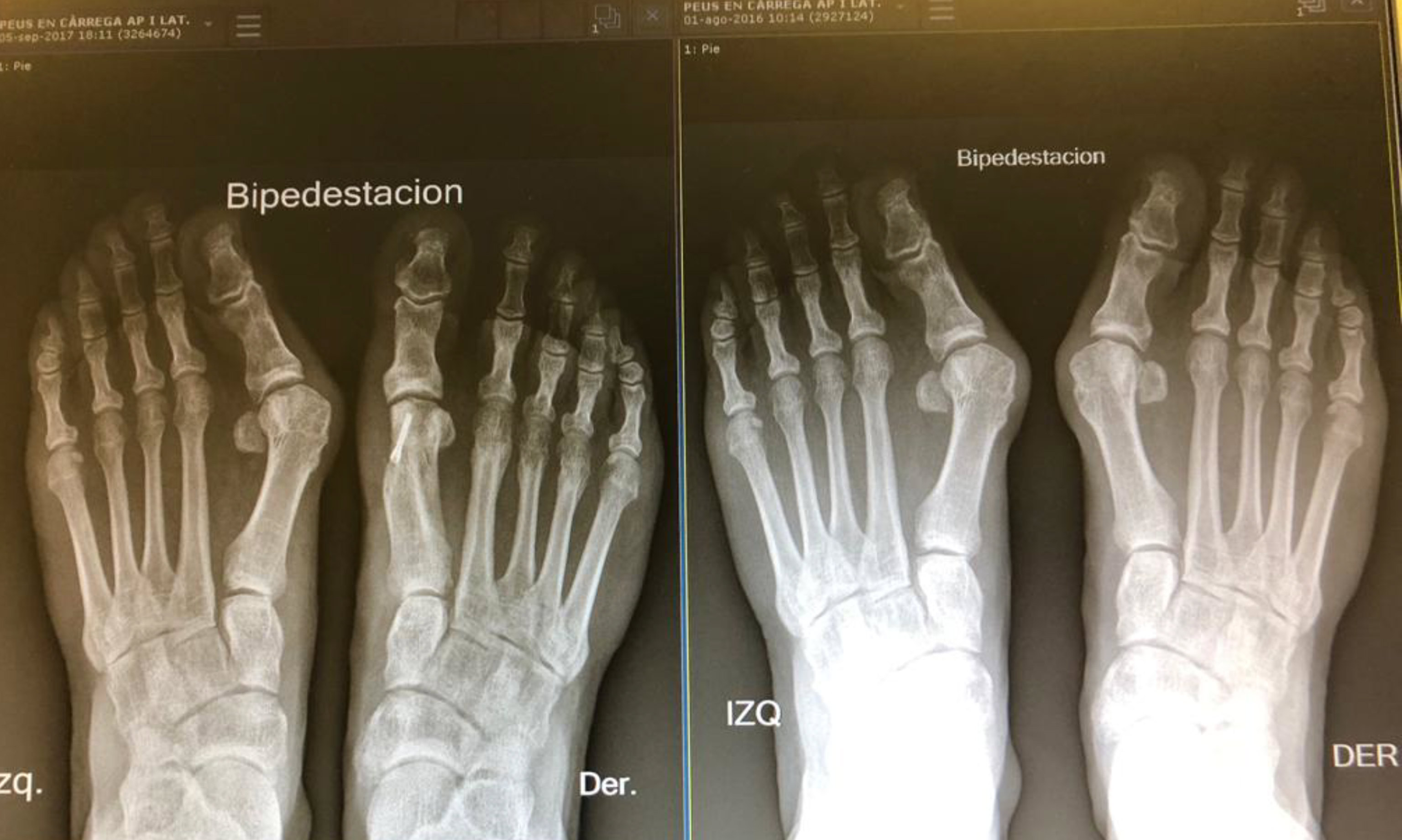 Cirugía de Hallux Valgus